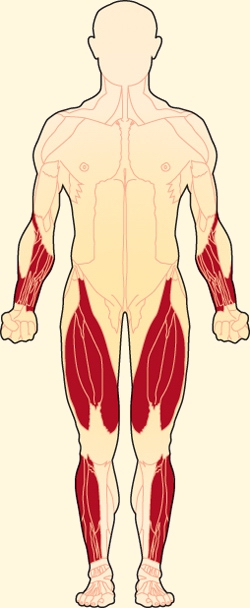 sIBM Atrophy
